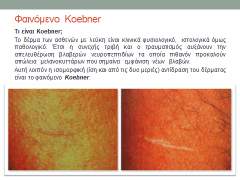 Φαινόμενο Koebner